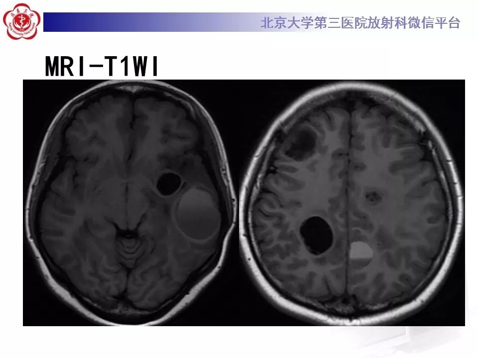 影像PPT - 【PPT】脑实质转移瘤-3