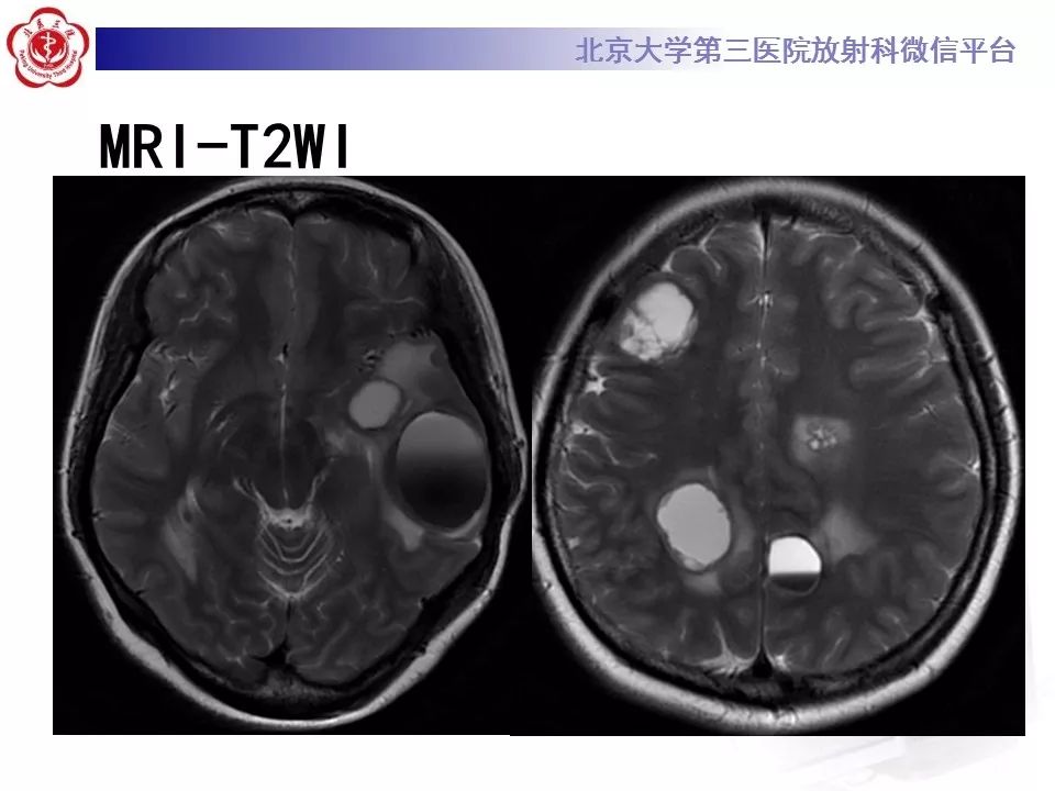 影像PPT - 【PPT】脑实质转移瘤-4