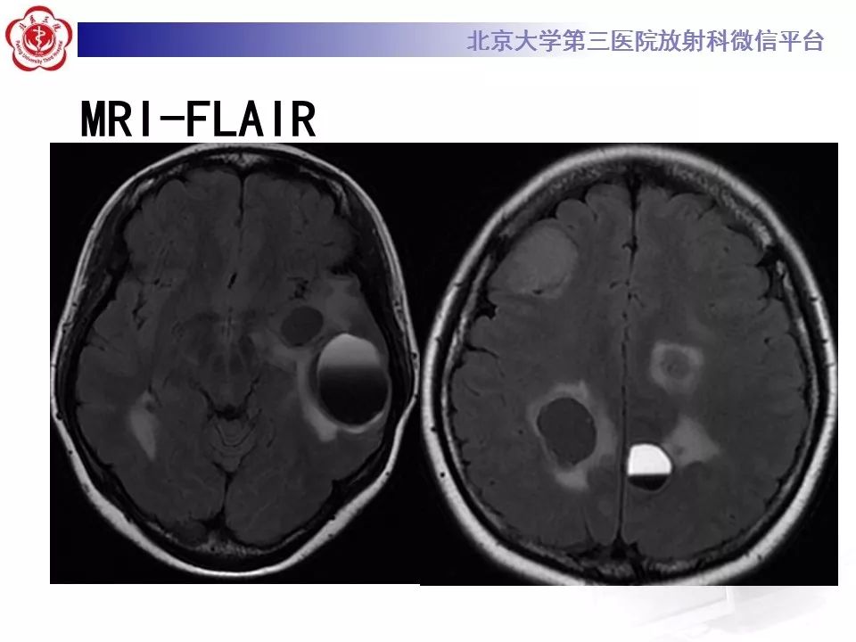 影像PPT - 【PPT】脑实质转移瘤-5