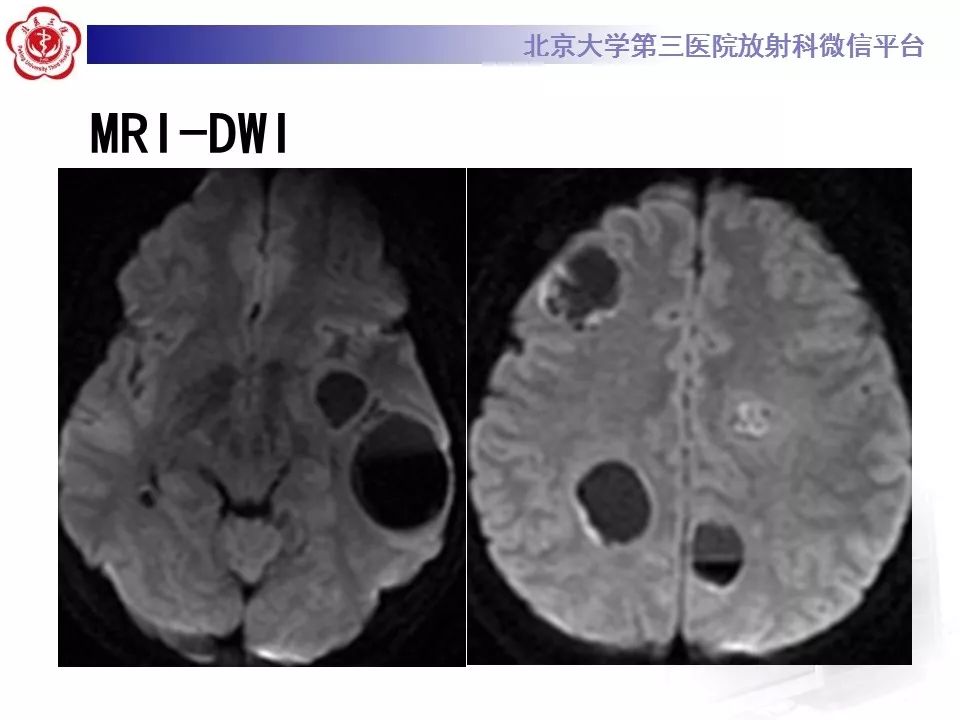 影像PPT - 【PPT】脑实质转移瘤-6