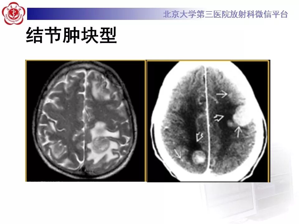 影像PPT - 【PPT】脑实质转移瘤-20