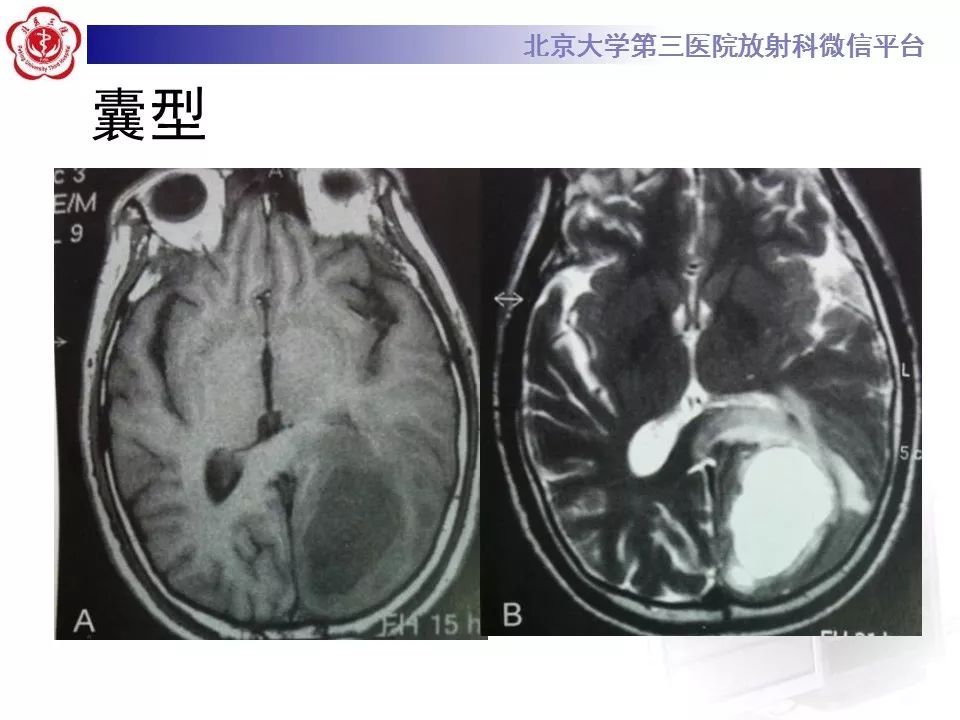 影像PPT - 【PPT】脑实质转移瘤-21