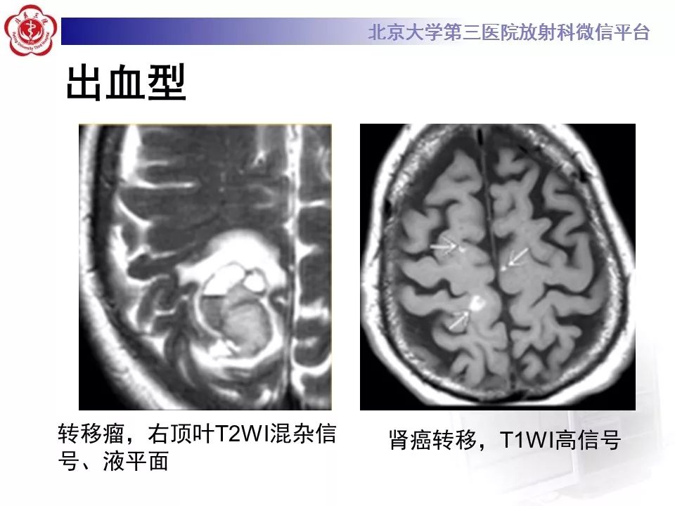影像PPT - 【PPT】脑实质转移瘤-22