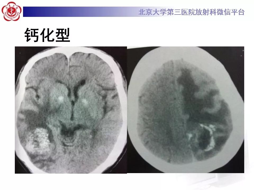 影像PPT - 【PPT】脑实质转移瘤-23