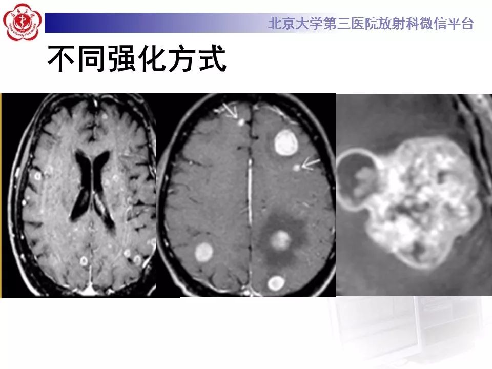 影像PPT - 【PPT】脑实质转移瘤-24