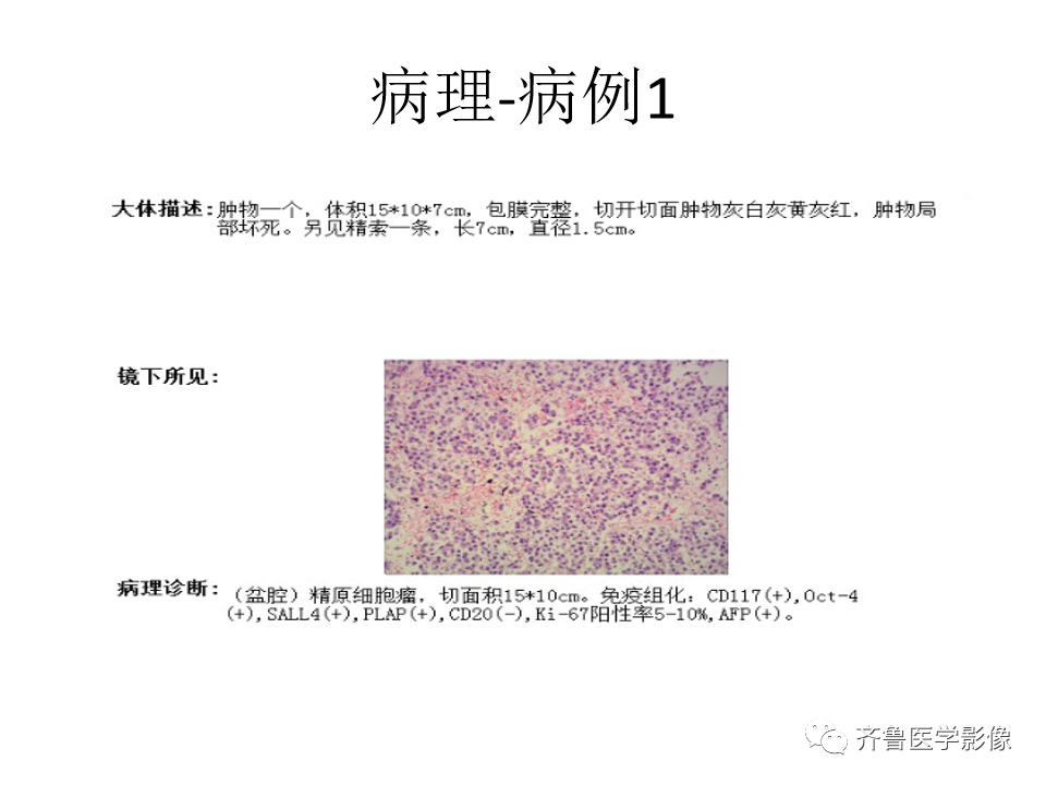影像PPT - 【病例】腹膜后精原细胞瘤2例影像特征-12