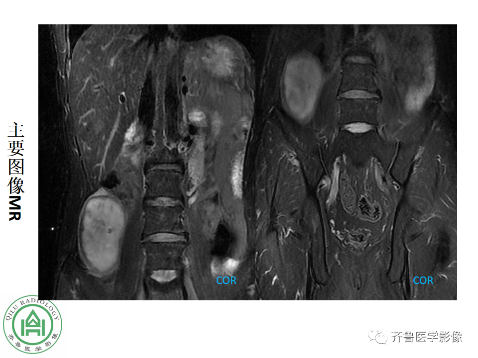 影像PPT - 【病例】腹膜后精原细胞瘤2例影像特征-10