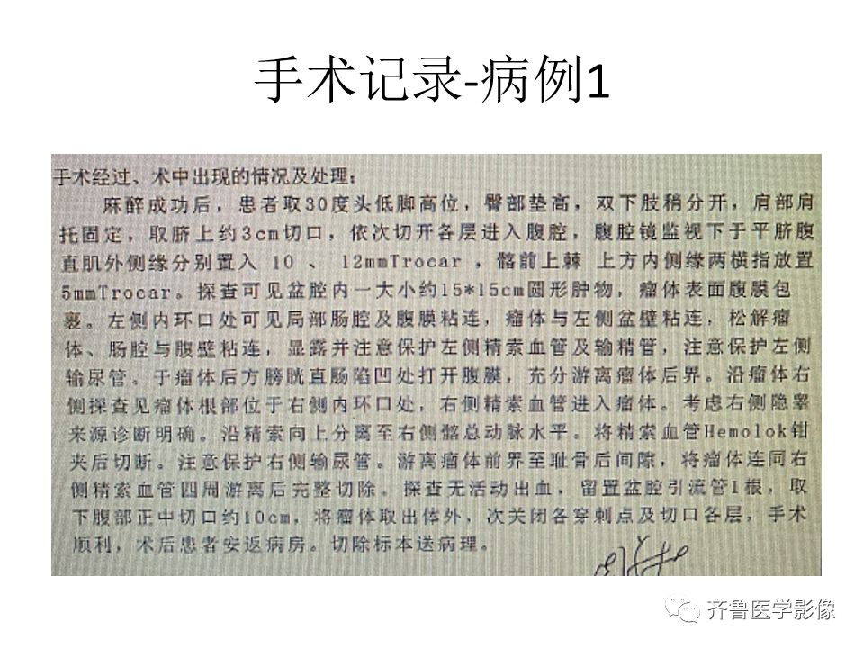 影像PPT - 【病例】腹膜后精原细胞瘤2例影像特征-11