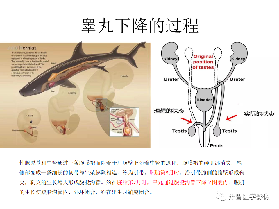 影像PPT - 【病例】腹膜后精原细胞瘤2例影像特征-15