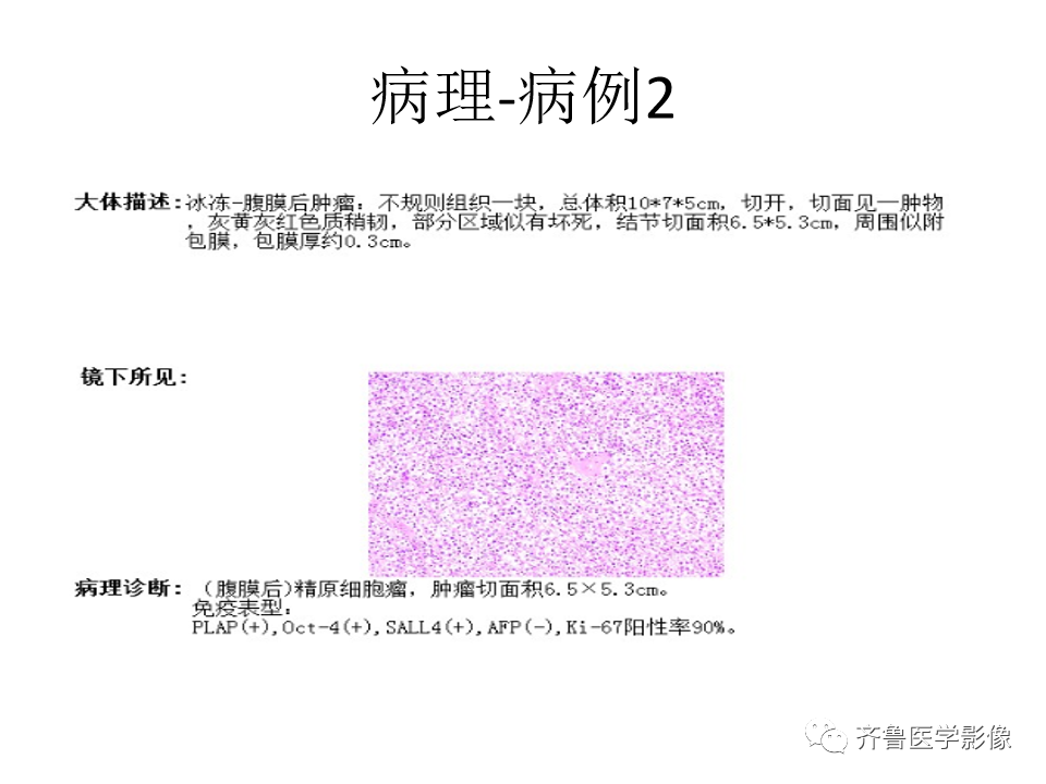 影像PPT - 【病例】腹膜后精原细胞瘤2例影像特征-14