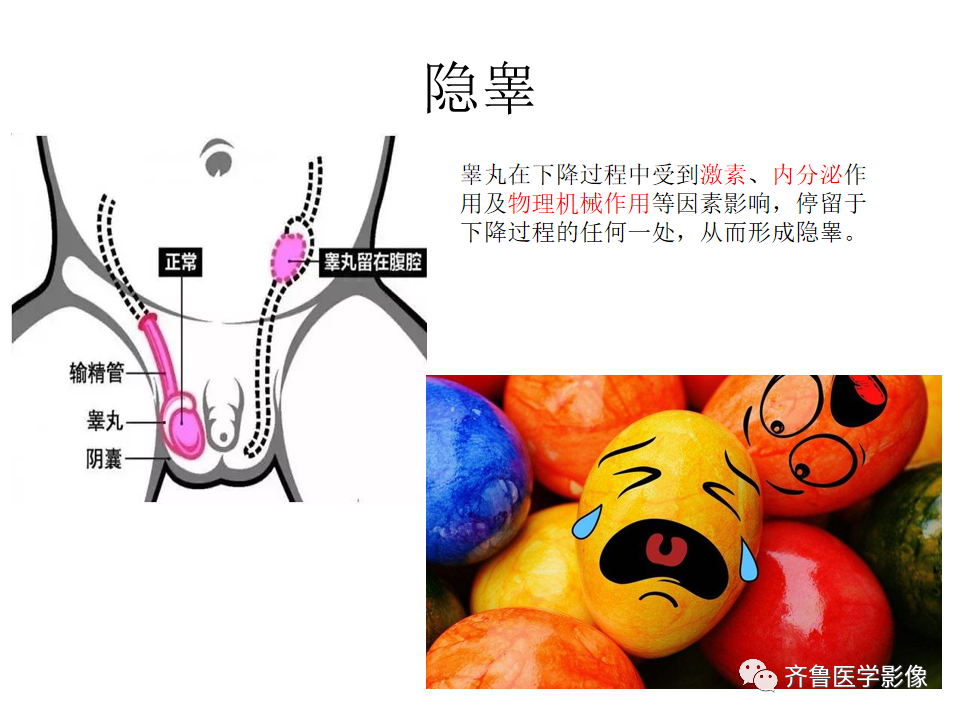 影像PPT - 【病例】腹膜后精原细胞瘤2例影像特征-16