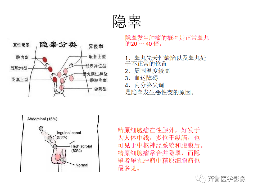 影像PPT - 【病例】腹膜后精原细胞瘤2例影像特征-17