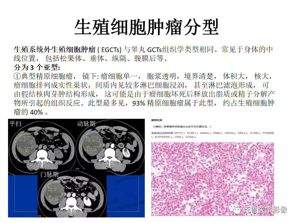 影像PPT - 【病例】腹膜后精原细胞瘤2例影像特征-18
