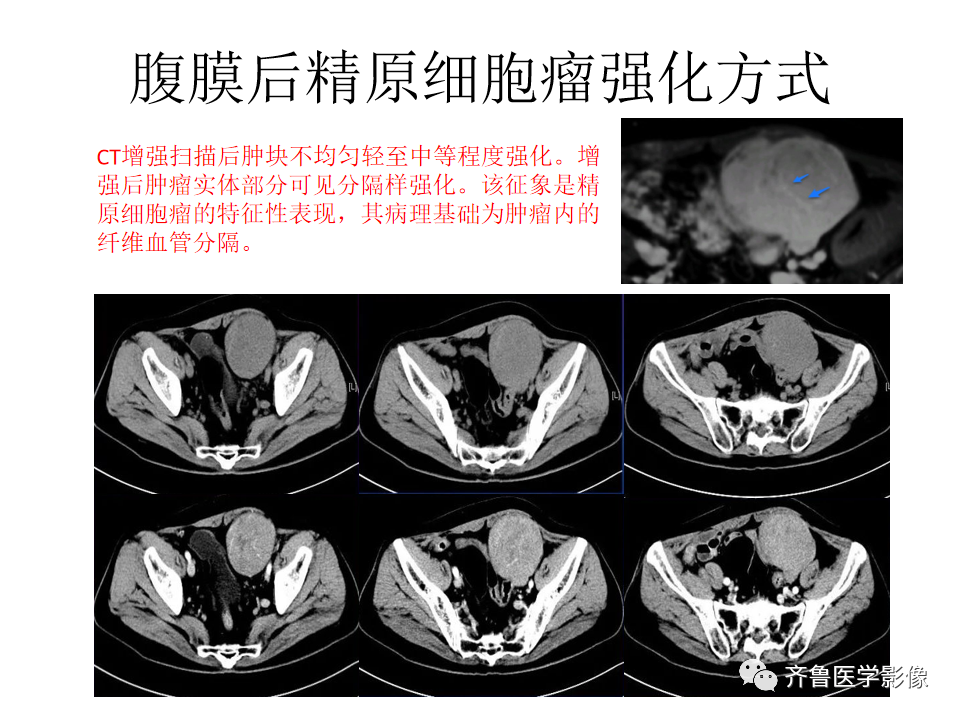 影像PPT - 【病例】腹膜后精原细胞瘤2例影像特征-22