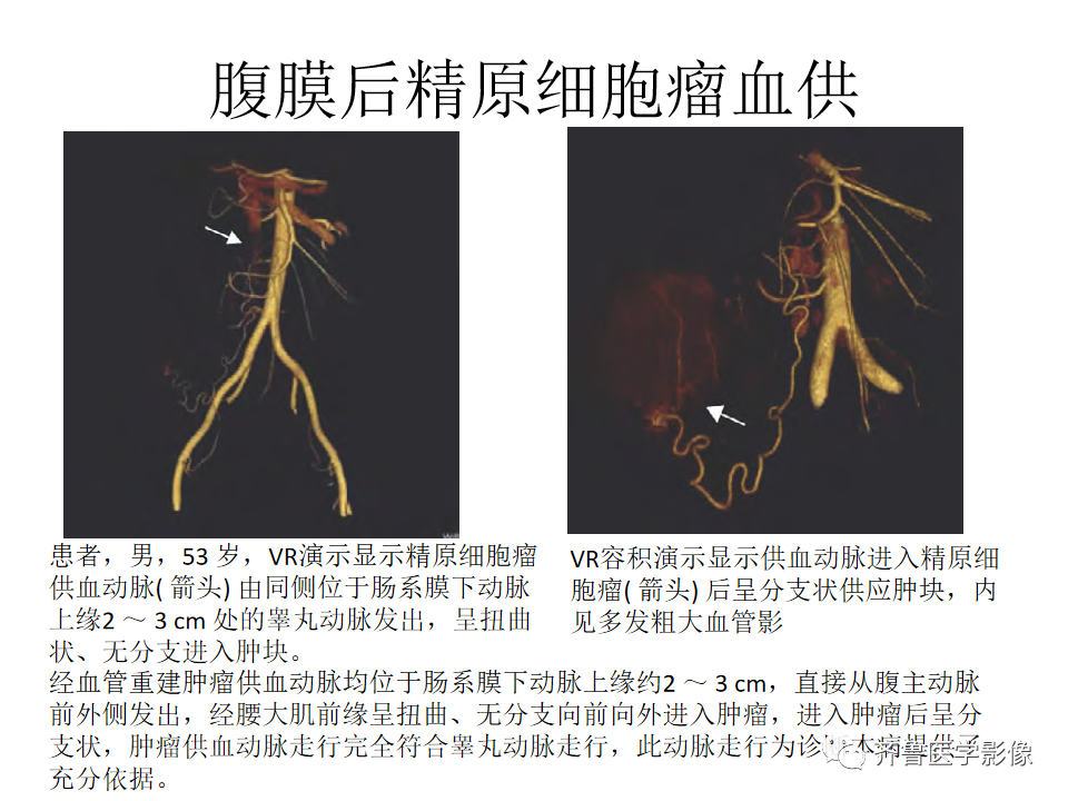 影像PPT - 【病例】腹膜后精原细胞瘤2例影像特征-25