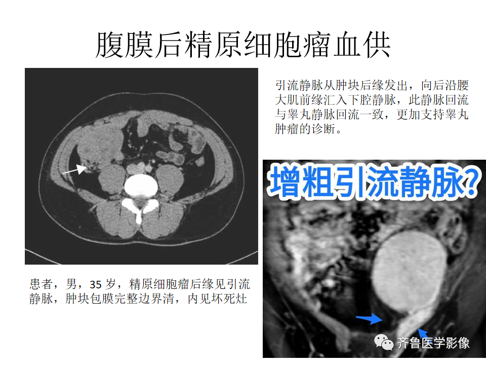 影像PPT - 【病例】腹膜后精原细胞瘤2例影像特征-27