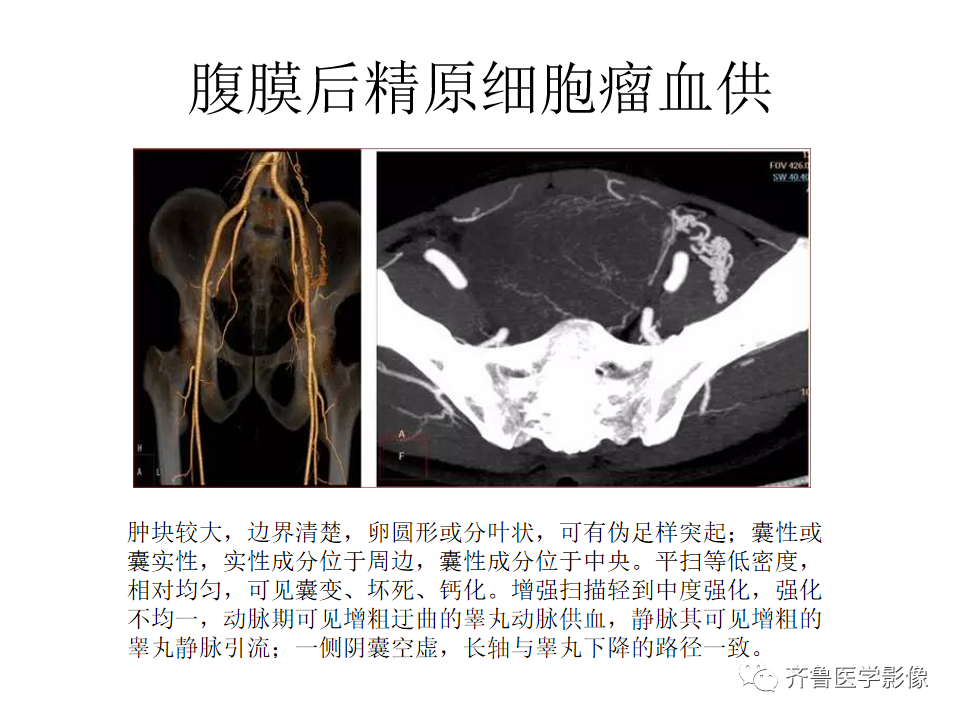 影像PPT - 【病例】腹膜后精原细胞瘤2例影像特征-26