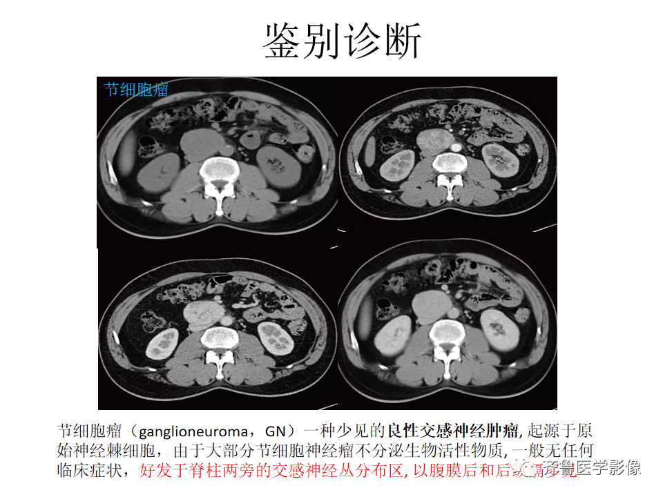 影像PPT - 【病例】腹膜后精原细胞瘤2例影像特征-30