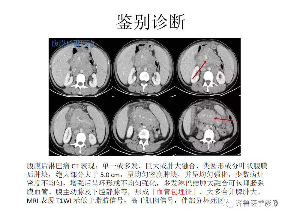 影像PPT - 【病例】腹膜后精原细胞瘤2例影像特征-29