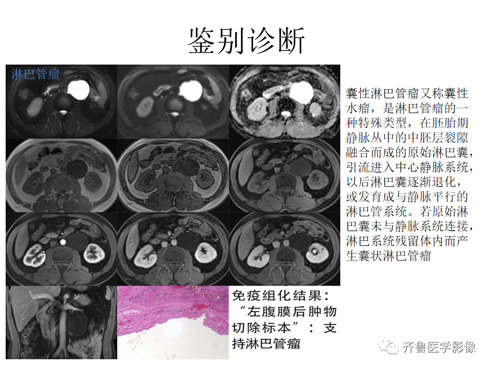 影像PPT - 【病例】腹膜后精原细胞瘤2例影像特征-31