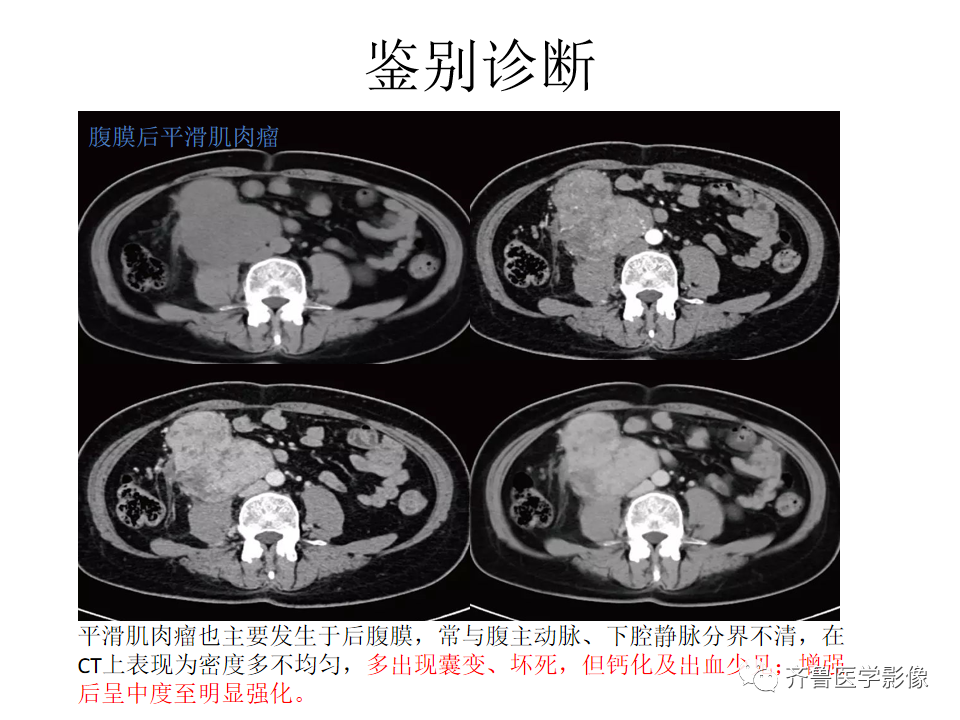 影像PPT - 【病例】腹膜后精原细胞瘤2例影像特征-28