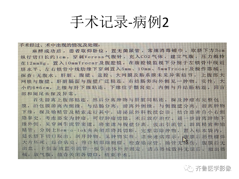 影像PPT - 【病例】腹膜后精原细胞瘤2例影像特征-13