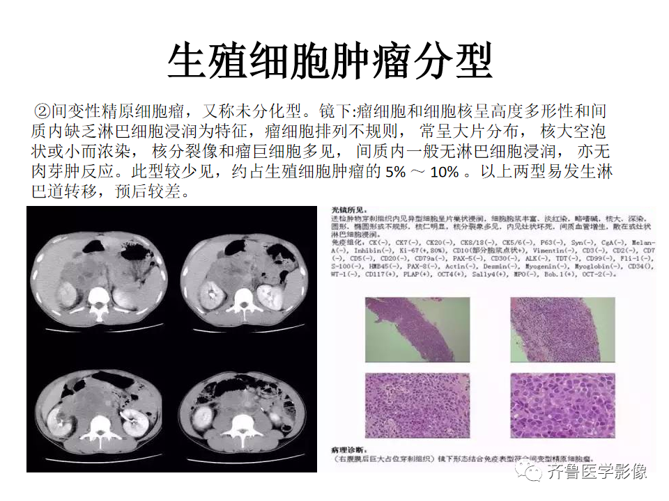 影像PPT - 【病例】腹膜后精原细胞瘤2例影像特征-19
