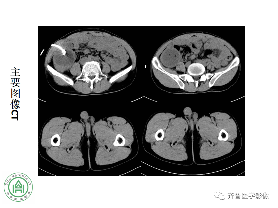 影像PPT - 【病例】腹膜后精原细胞瘤2例影像特征-8