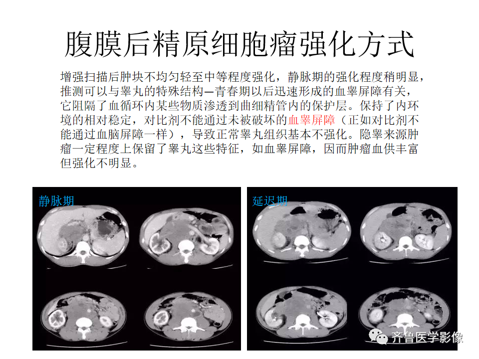 影像PPT - 【病例】腹膜后精原细胞瘤2例影像特征-23