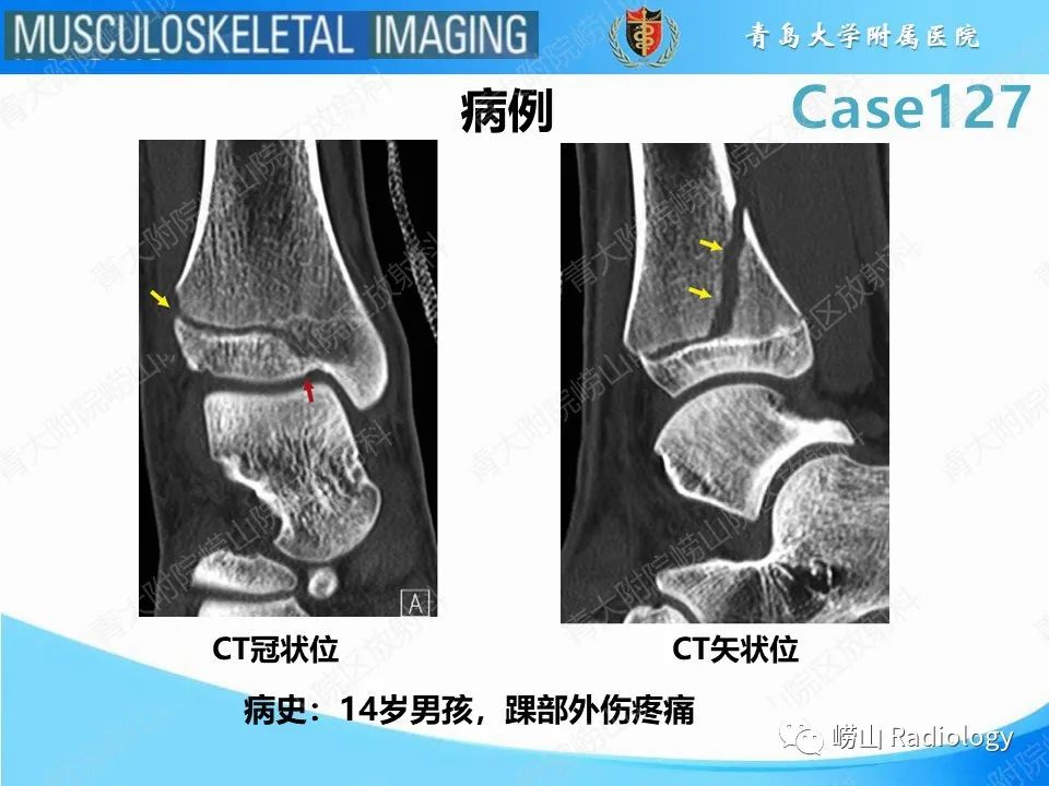 影像PPT - 【PPT】三平面骨折-2