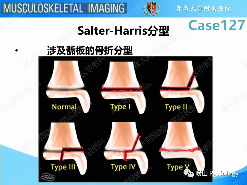 影像PPT - 【PPT】三平面骨折-12