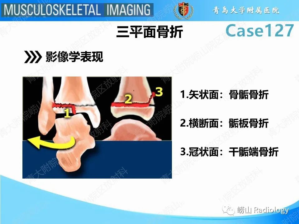 影像PPT - 【PPT】三平面骨折-14