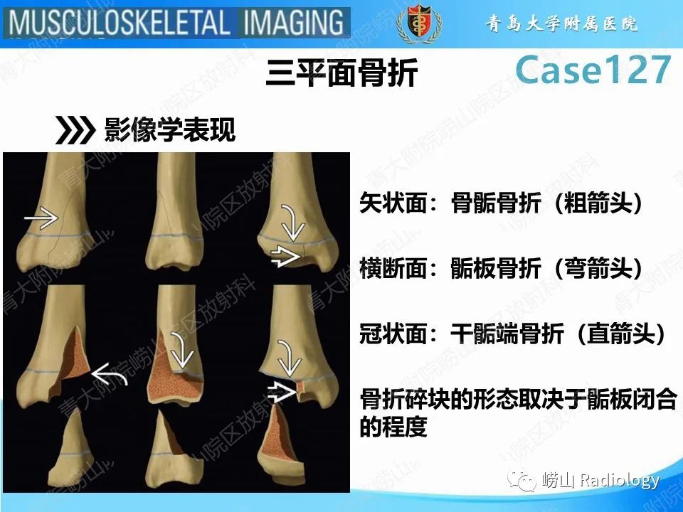 影像PPT - 【PPT】三平面骨折-15