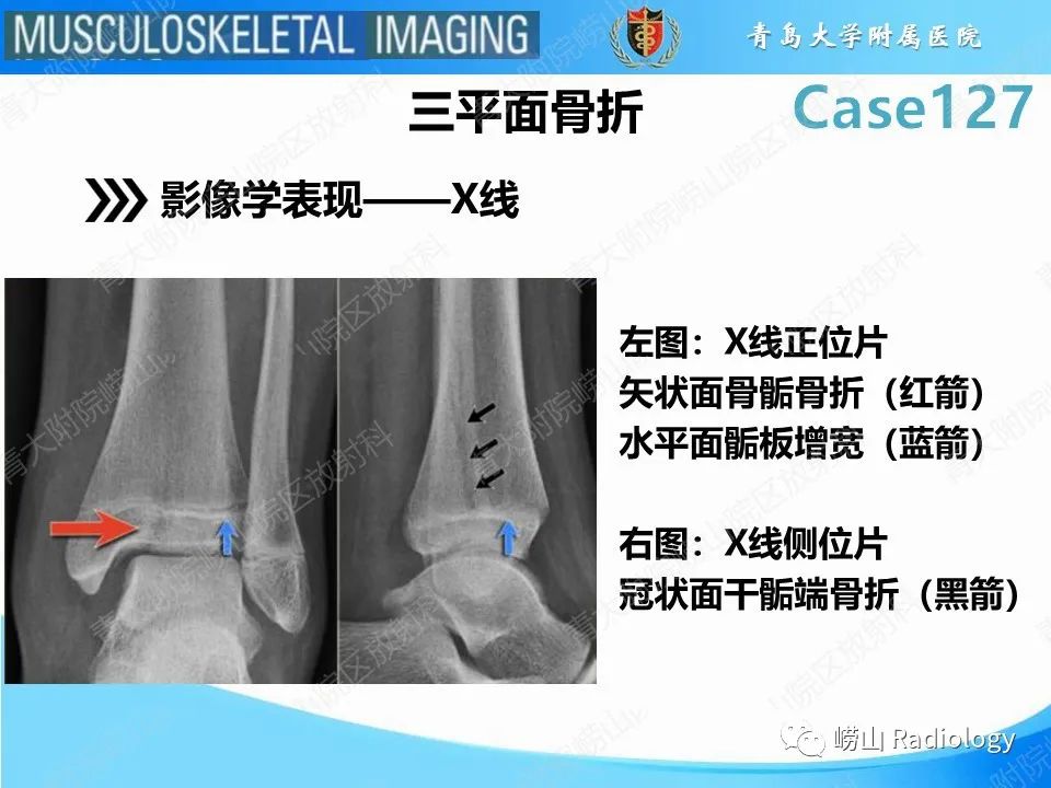 影像PPT - 【PPT】三平面骨折-16
