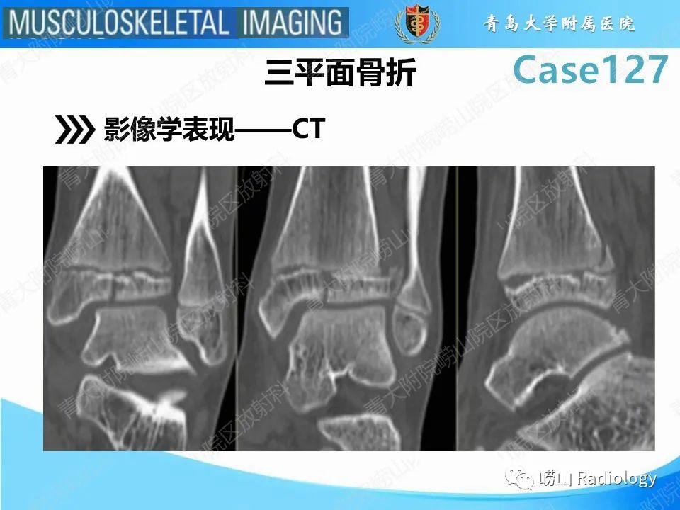 影像PPT - 【PPT】三平面骨折-17