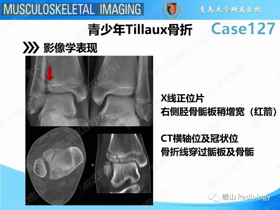 影像PPT - 【PPT】三平面骨折-19