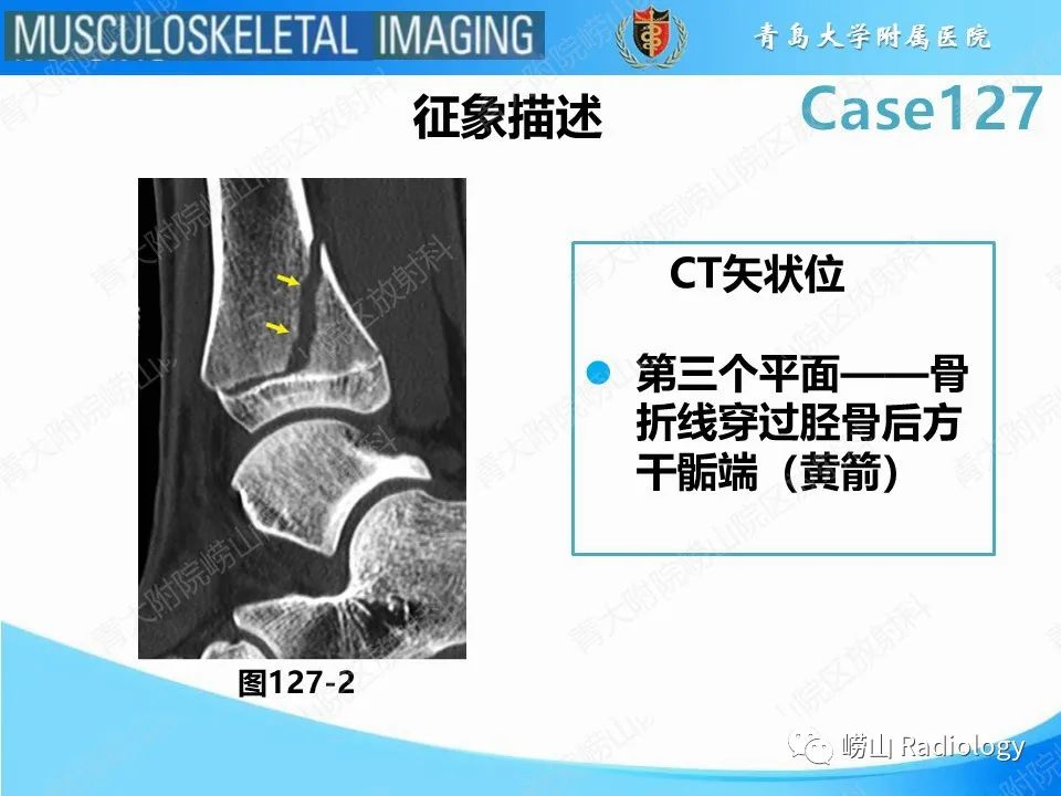 影像PPT - 【PPT】三平面骨折-21