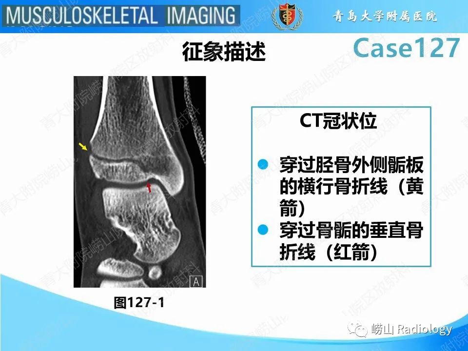 影像PPT - 【PPT】三平面骨折-20