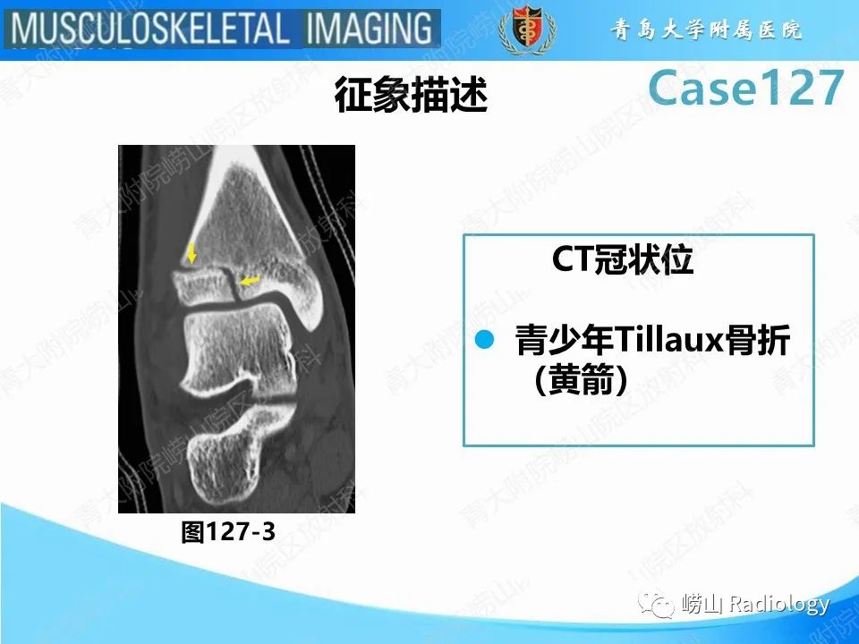 影像PPT - 【PPT】三平面骨折-22