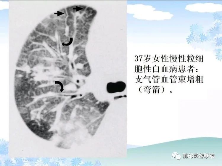 影像PPT - 【PPT】白血病肺部浸润CT诊断与鉴别-8