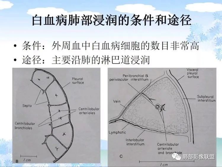 影像PPT - 【PPT】白血病肺部浸润CT诊断与鉴别-5