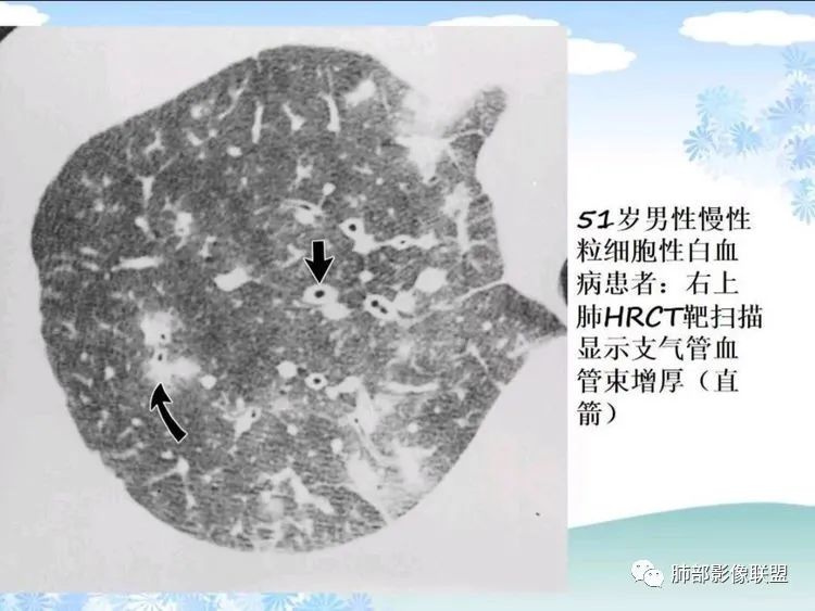 影像PPT - 【PPT】白血病肺部浸润CT诊断与鉴别-9