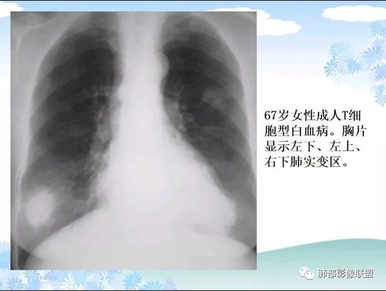影像PPT - 【PPT】白血病肺部浸润CT诊断与鉴别-21