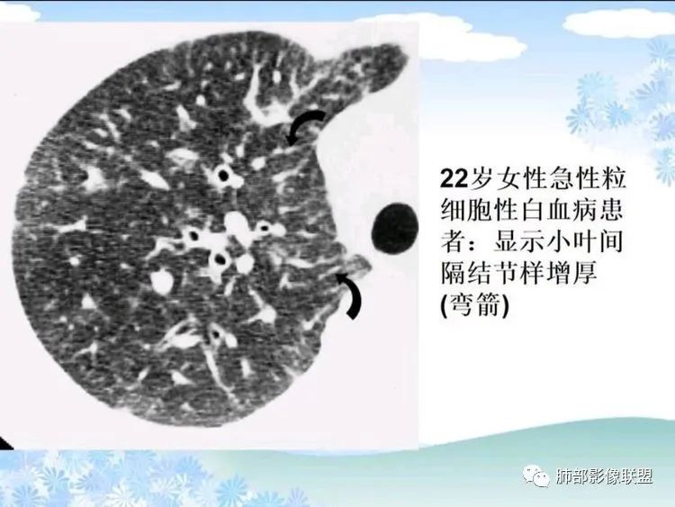 影像PPT - 【PPT】白血病肺部浸润CT诊断与鉴别-12