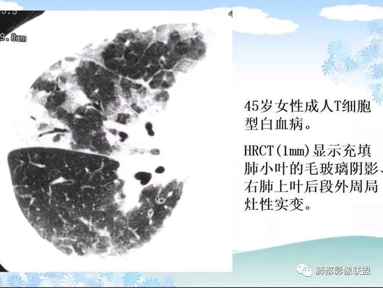影像PPT - 【PPT】白血病肺部浸润CT诊断与鉴别-18