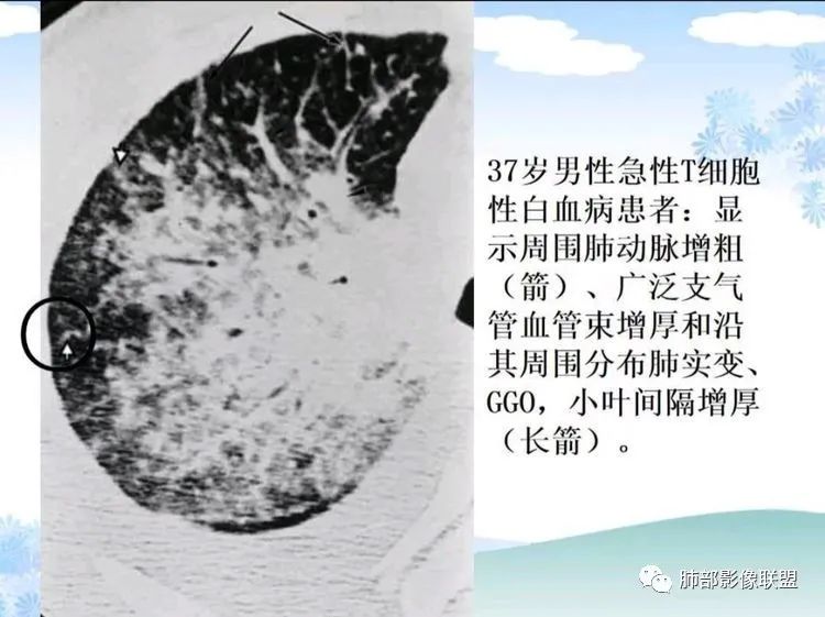 影像PPT - 【PPT】白血病肺部浸润CT诊断与鉴别-15