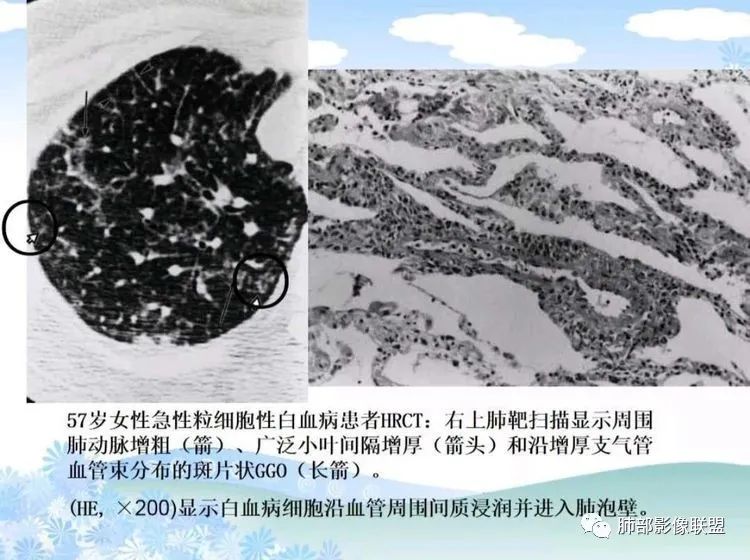 影像PPT - 【PPT】白血病肺部浸润CT诊断与鉴别-14
