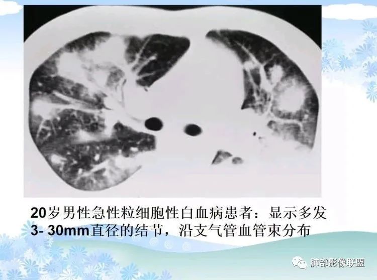 影像PPT - 【PPT】白血病肺部浸润CT诊断与鉴别-25