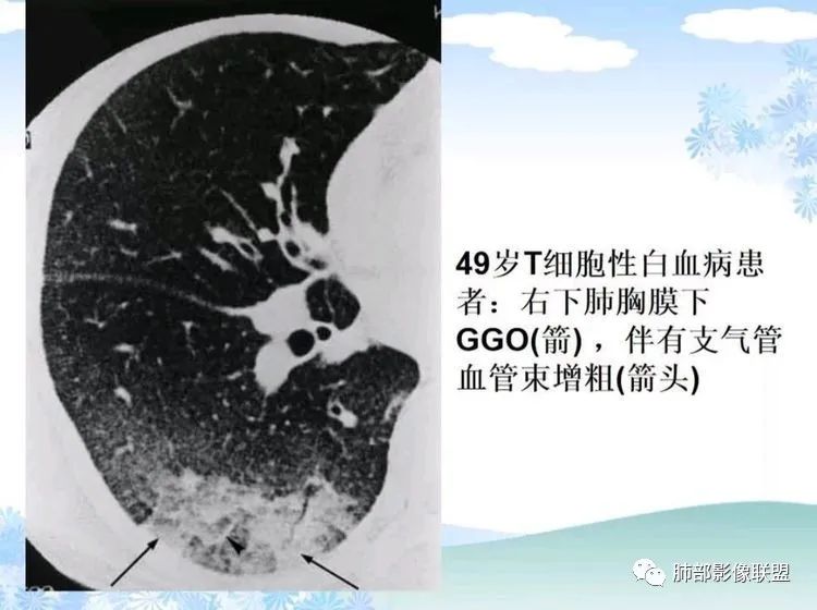 影像PPT - 【PPT】白血病肺部浸润CT诊断与鉴别-17