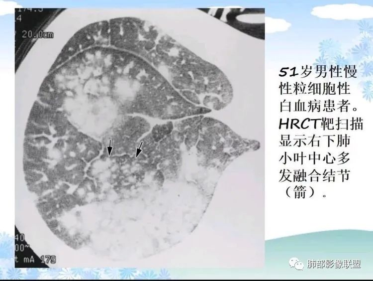 影像PPT - 【PPT】白血病肺部浸润CT诊断与鉴别-26